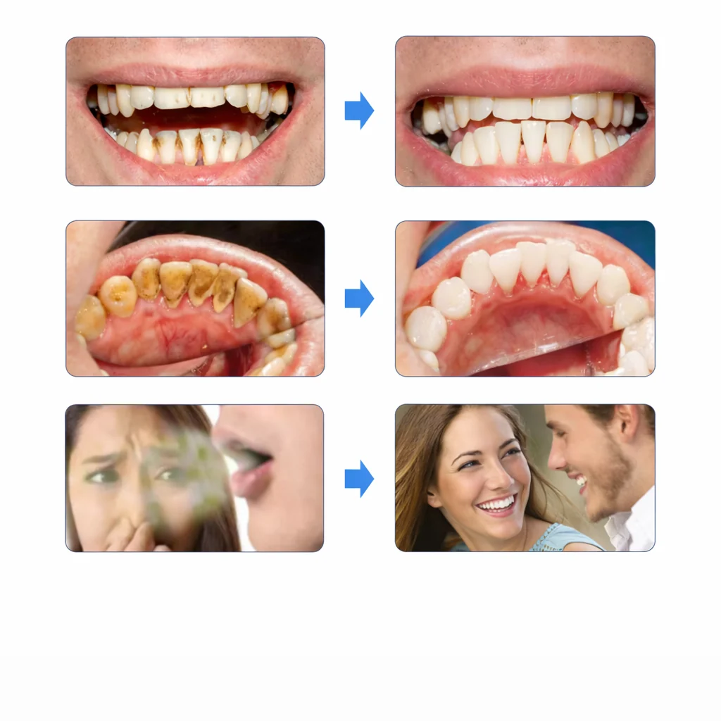 GlowSmile™ – Ultraljudsrengöring - Bild 9